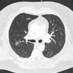 Image A. CT scan 1, one week prior to admission 