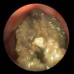 Image A. Bronchoscopy