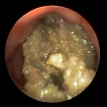 Image A. Bronchoscopy