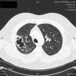 HR CT chest (January 2008) showing thick walled, multiloculated cavity and dilated bronchial cavities in the right upper lobe associated with cystic and varicose bronchiectasis.
