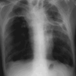 Chest X Ray 22/12/00