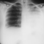 Image A. Her chest x-ray (Oct 04) shows consolidation of her left lower lobe with slight mediastinal shift, but some diaphragmatic elevation.