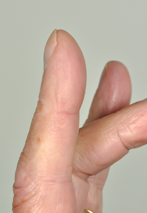 Pt FM Chronic pulmonary aspergillosis clubbing 1