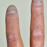 Pt FM Chronic pulmonary aspergillosis clubbing 2