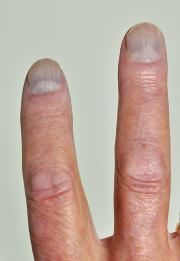 Figure 3 from Expert Review Examination for Finger Clubbing | Semantic  Scholar