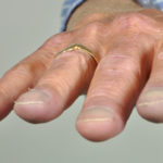 Pt FM Chronic pulmonary aspergillosis clubbing 3