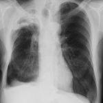 Pt FM Chronic pulmonary aspergillosis xray 1