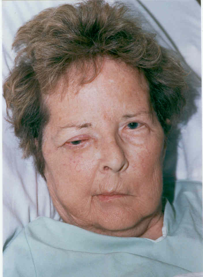 Case 43, ptSW Orbital aspergillosis with late fungemia