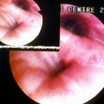 bronchial oedema