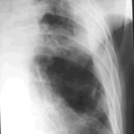 Chest X-ray  18/8/99 (left side)