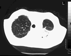14/5/99 Compare with B, showing progressive enlargement of cavity and formation of fungal ball.