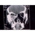 Chronic invasive sinus aspergillosis caused by Aspergillus terreus