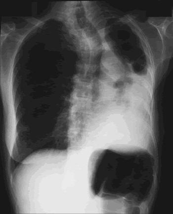 Image B. Significant progression of the two cavities at the left apex, which have merged into one is apparent.