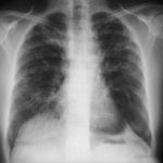 pt ar sarcoidosis ccpa