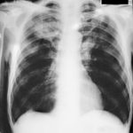Immune reconstitution syndrome