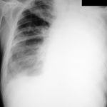 Chest X ray (+87 days)