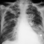 Chest X ray (+64 days)