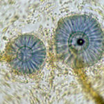 Aspergillus ochraceopetaliformis onychomycosis 3