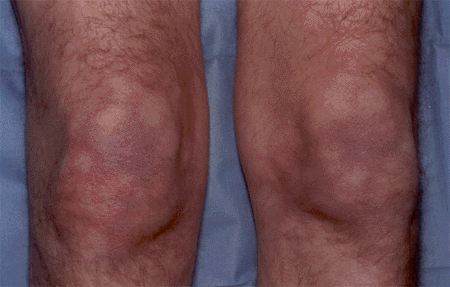 Livido reticularis 1
