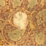 Oxalate crystals in a renal tubule 1
