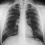 Image A. 31/3/99 FEV1= 3.00, ABPA RAST =31, IgE = 1900.  No Rx 