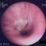 Patient VE - Plugging of airways with mucus 1