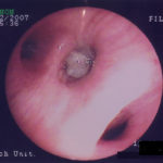 Patient VE - Plugging of airways with mucus 2