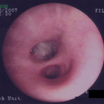 Patient VE - Plugging of airways with mucus 3
