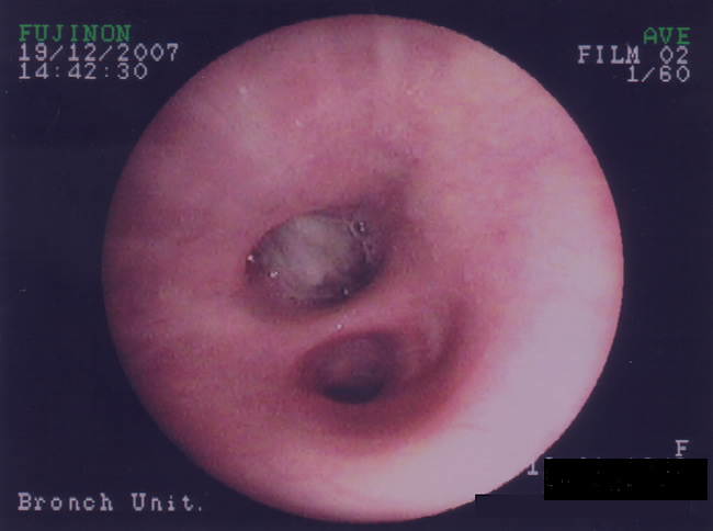 Patient VE - Plugging of airways with mucus 3