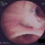 Patient VE - Plugging of airways with mucus 4