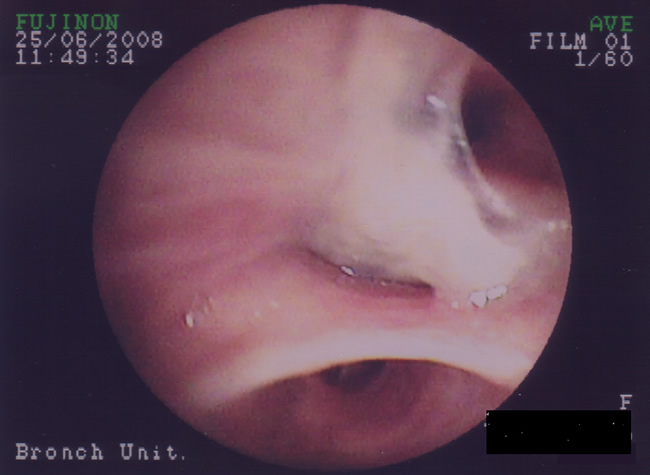 Patient VE - Plugging of airways with mucus 4