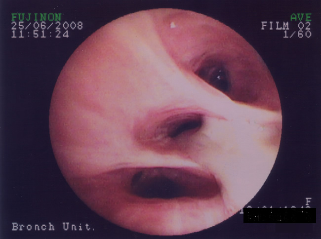 Patient VE - Plugging of airways with mucus 5