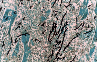 Skeletal muscle - invasive aspergillosis showing dichotomously branching hyphae x100