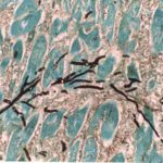 Skeletal muscle - invasive aspergillosis showing dichotomously branching hyphae x300