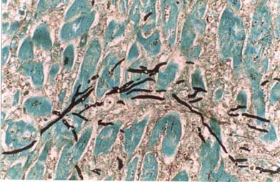 Skeletal muscle - invasive aspergillosis showing dichotomously branching hyphae x300