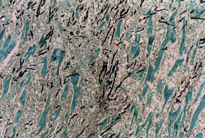 Skeletal muscle - invasive aspergillosis showing dichotomously branching hyphae