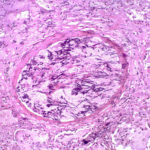 blood vessel invasion