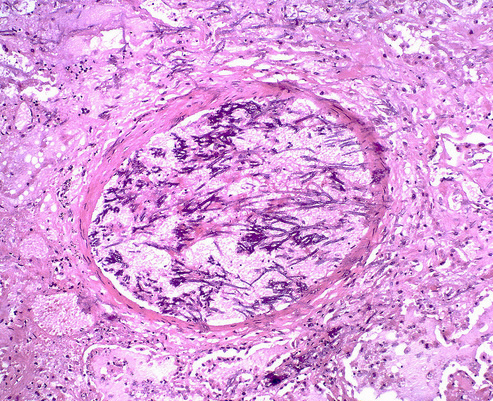 blood vessel invasion