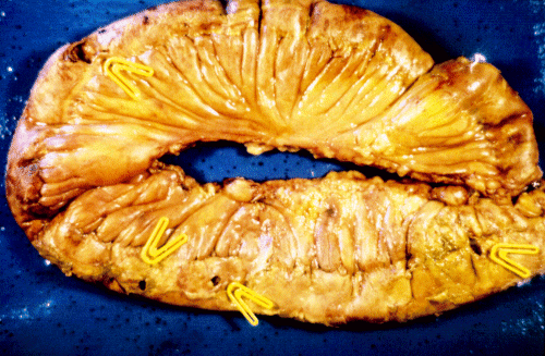 intestinal 2