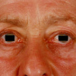 ocular redness 2