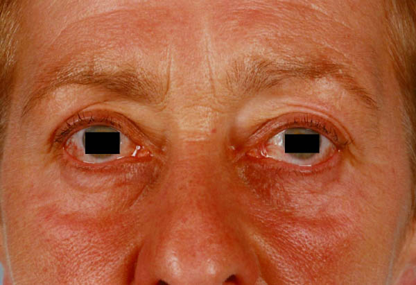 ocular redness 2