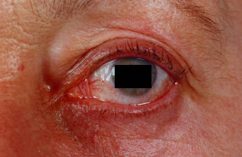 ocular redness