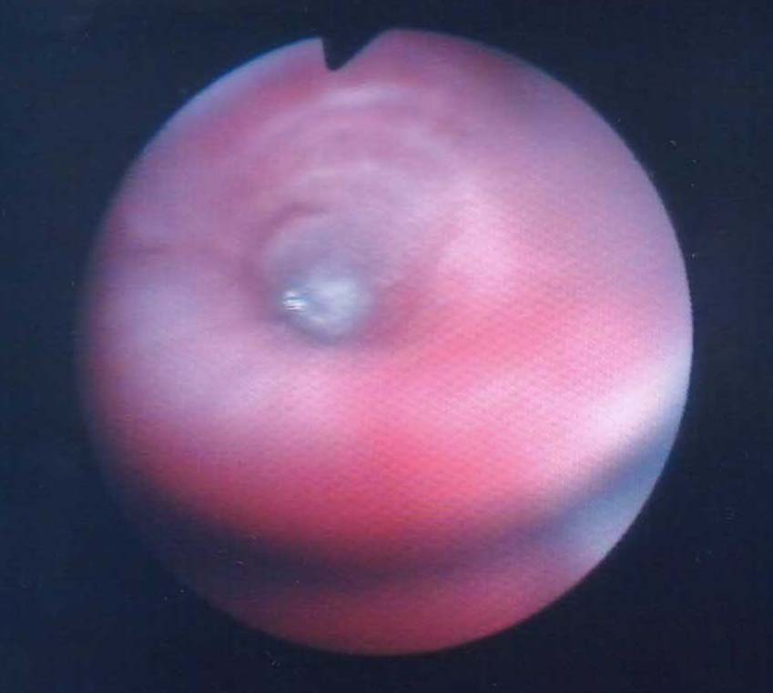 A long mucus plug was seen plugging the right middle lobe orifice. This was removed. 