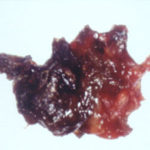 staining of eosinophilic mucin 3