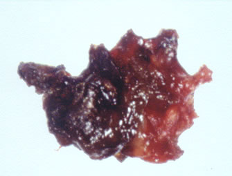 staining of eosinophilic mucin 3