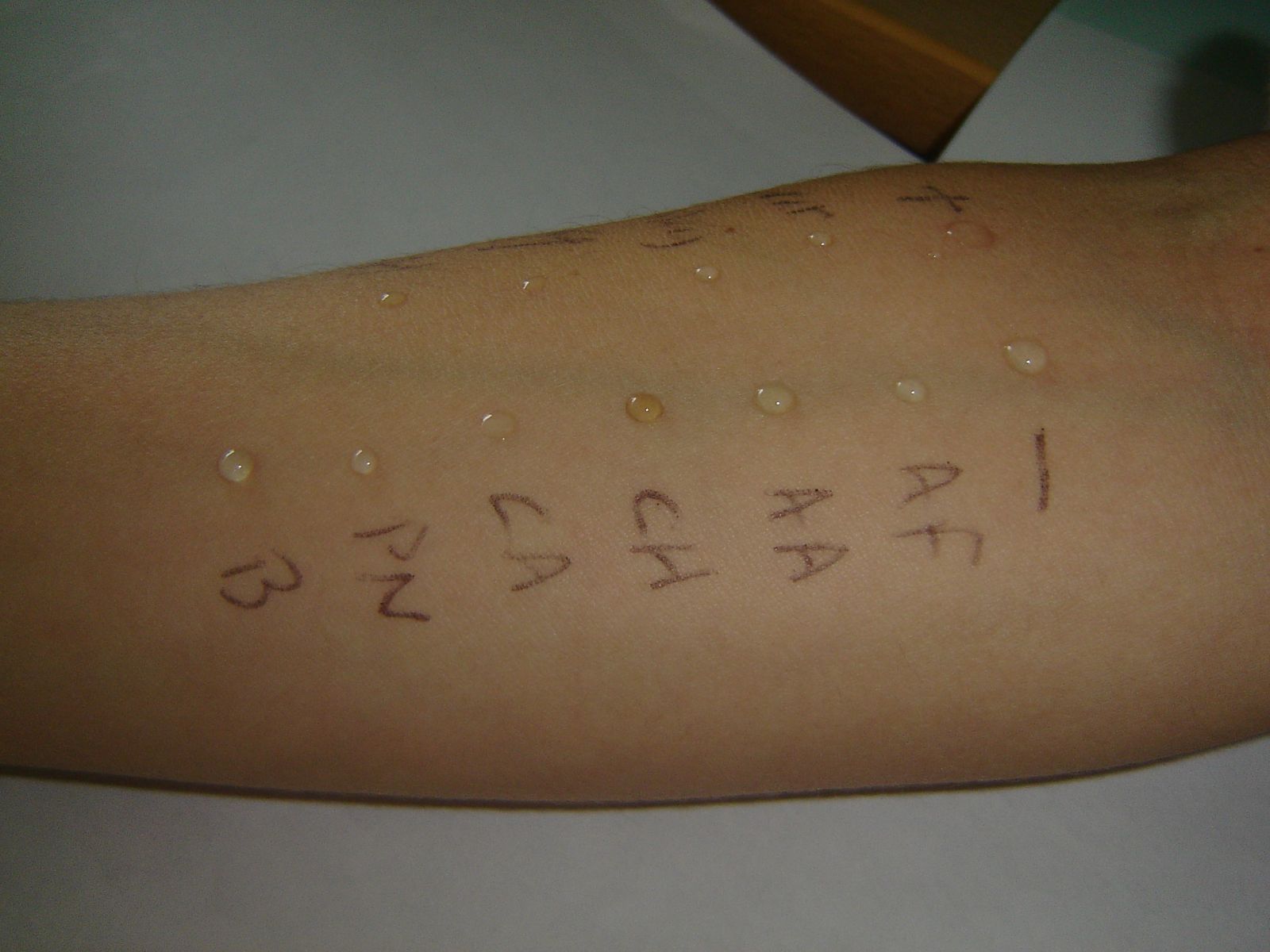 Allergy Testing: Purpose, Procedure, And Results