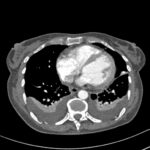 PtSD1 CT scan Jan 14