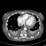 PtSD2  CT scan2 Jan 14