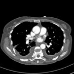 PtSD3 CT scan3 Jan 14