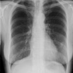PtSD2 Congestive heart failure with Itraconazole Chest x ray May14